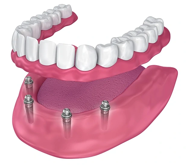 Complete Dental Services in Hallandale Beach, FL | Aventura Dental Center