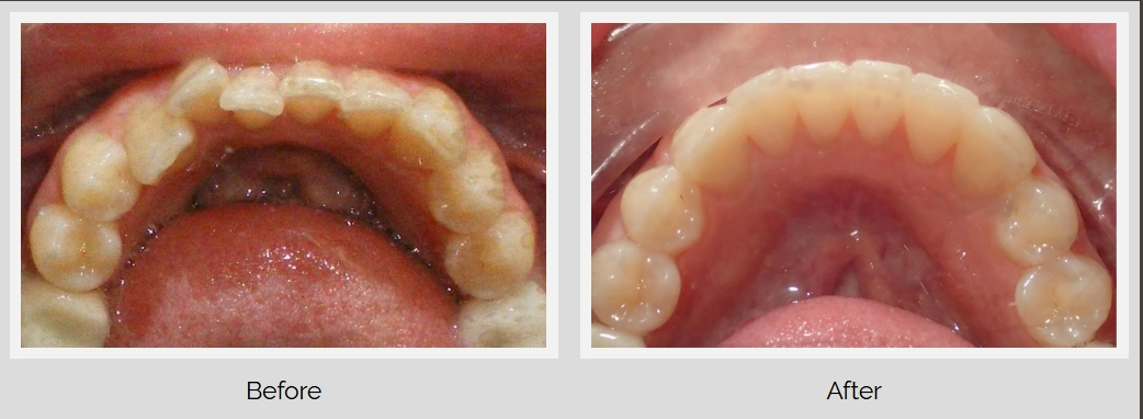 Before and after smile transformation showing teeth alignment improvement