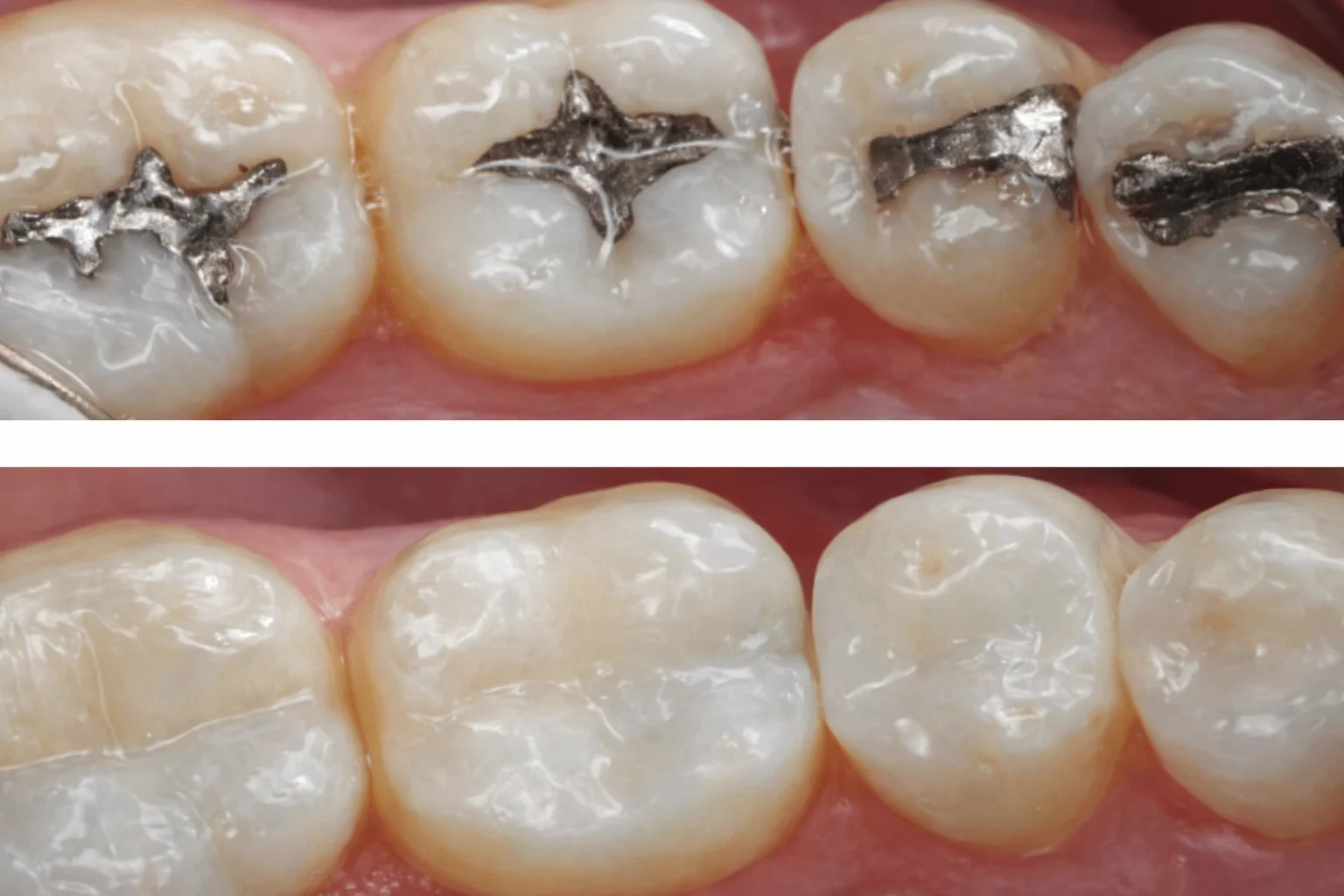 Dental Fillings in Aventura, FL: What They Are and When You Need Them