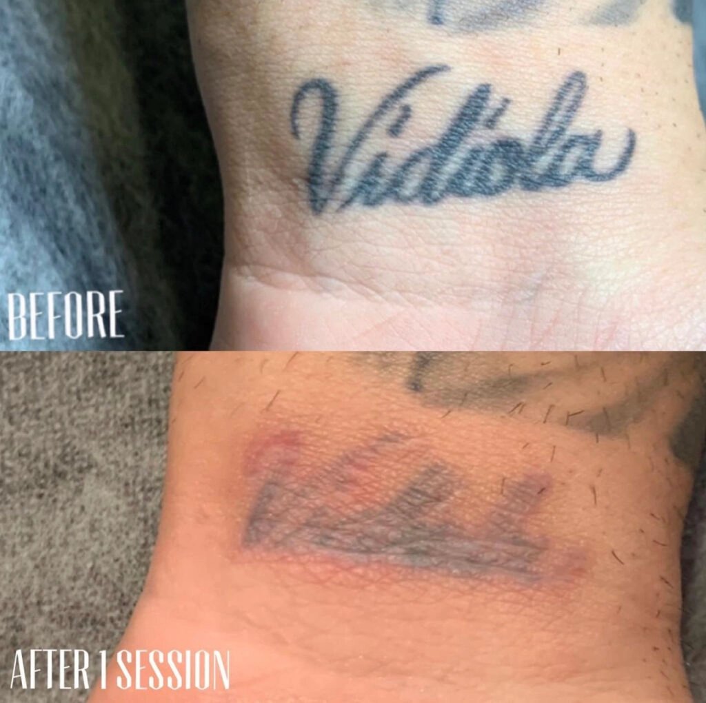 Saline Tattoo Removal 