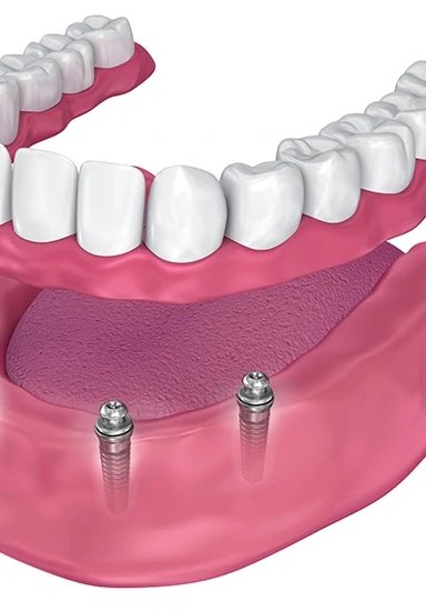 All-on-4 Implants
