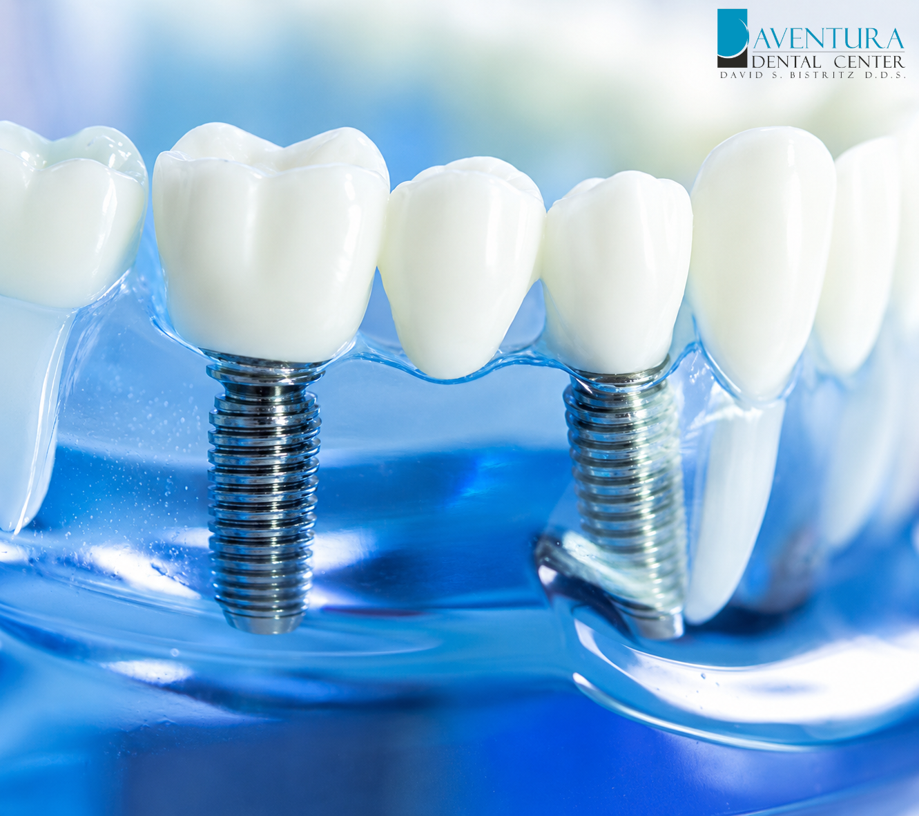 Your Go-To Guide for Dental Implants: Smile Brighter in Aventura, FL
