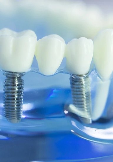 Close-up of dental implants in a model jaw.