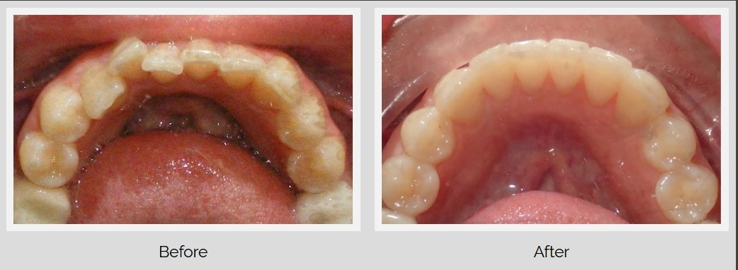 Before and after smile transformation showing teeth alignment improvement