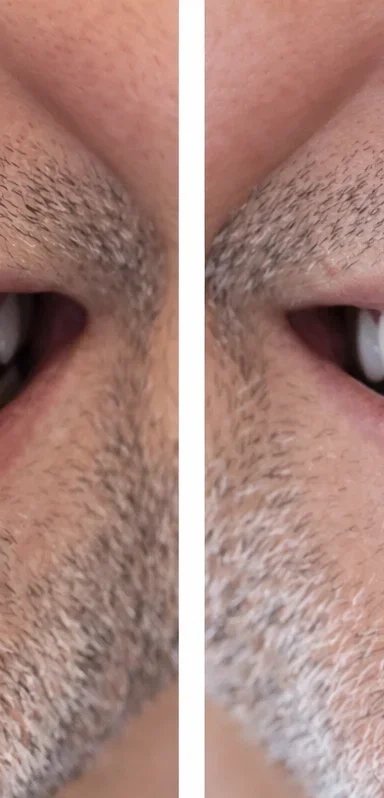 Before and after dental transformation showing improved smile