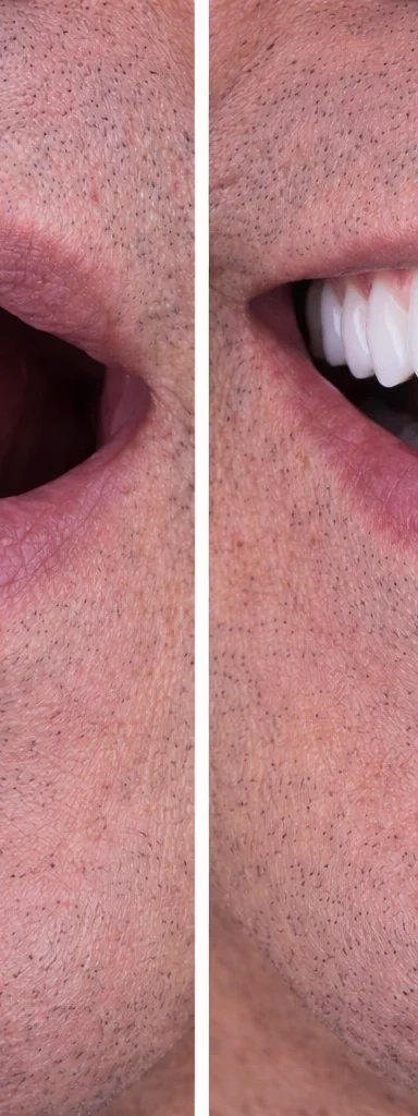 Before and after image of a person's smile.