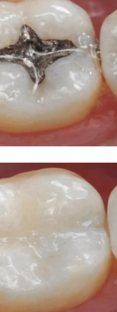Before and after dental treatment showing teeth restoration